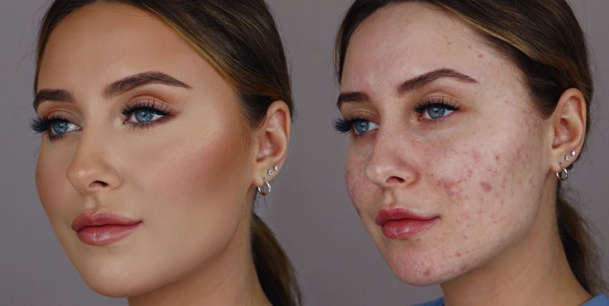 How to Cover Scars with Makeup: Expert Tips to Hide Scars